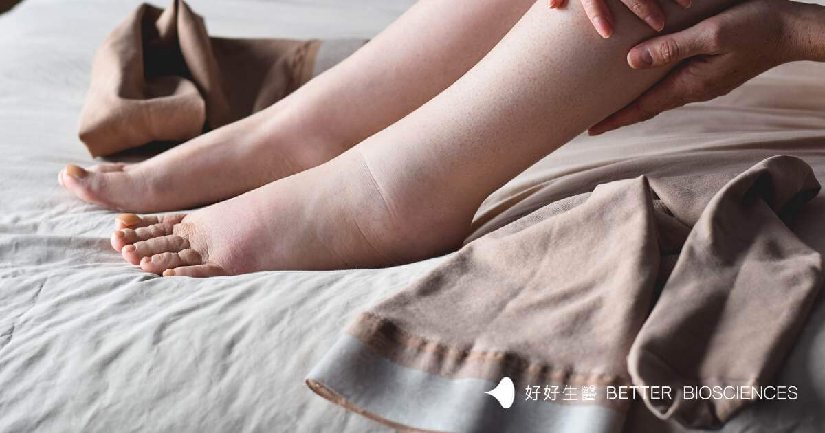 水腫怎麼消?營養師揭 7 大原因+最快消腫方法(飲食+穴道一次看)